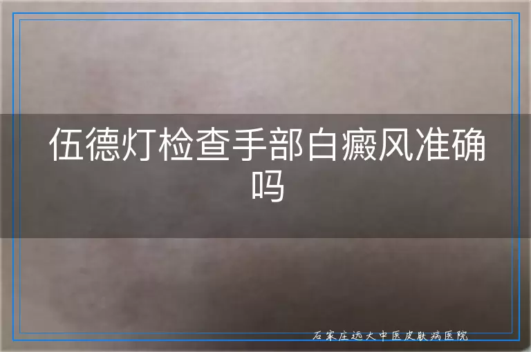 伍德灯检查手部白癜风准确吗