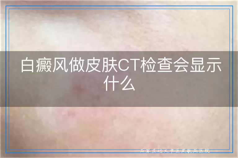 白癜风做皮肤CT检查会显示什么