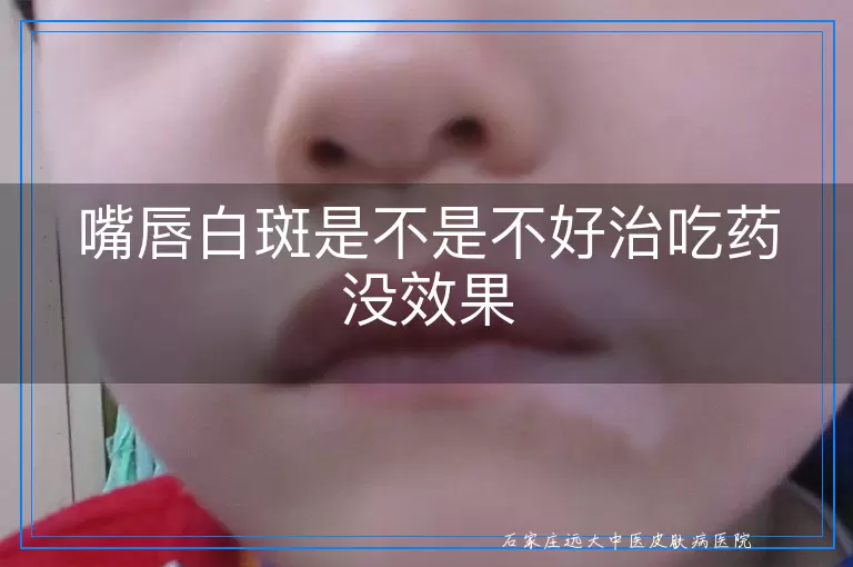 嘴唇白斑是不是不好治吃药没效果