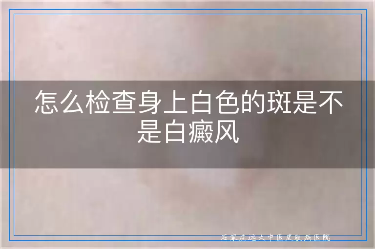 怎么检查身上白色的斑是不是白癜风