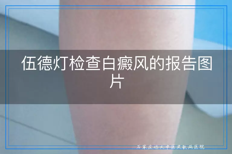 伍德灯检查白癜风的报告图片
