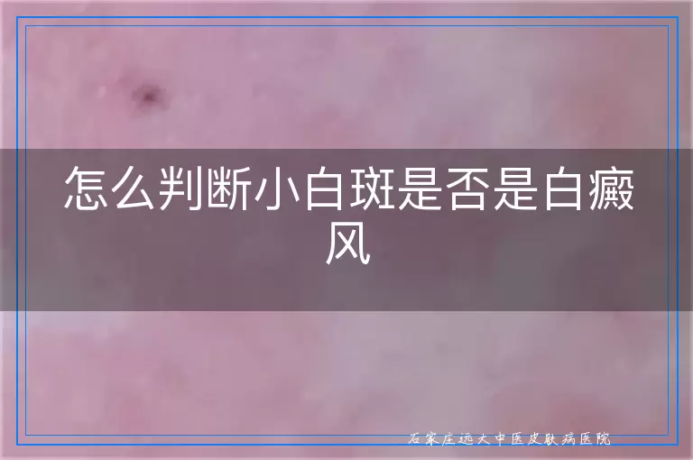 怎么判断小白斑是否是白癜风