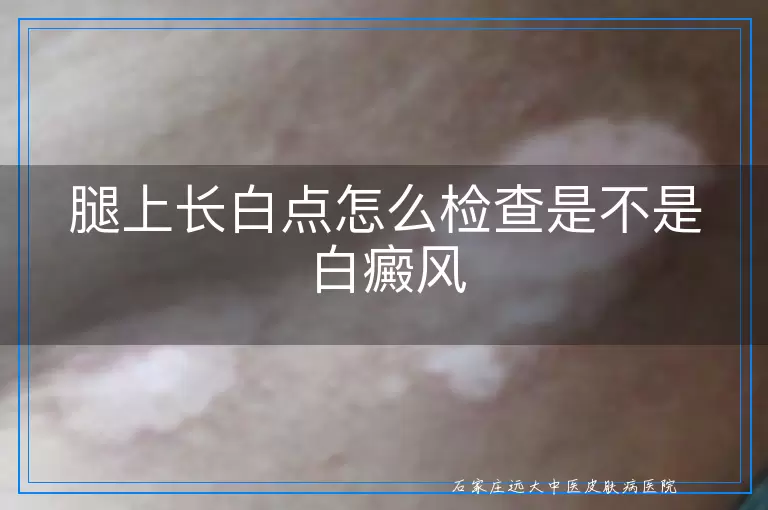 腿上长白点怎么检查是不是白癜风