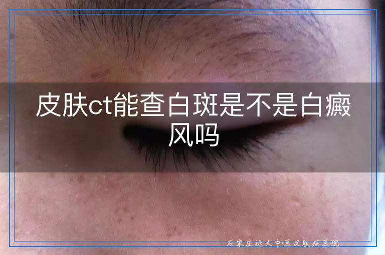 皮肤ct能查白斑是不是白癜风吗