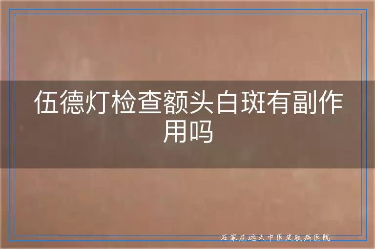 伍德灯检查额头白斑有副作用吗