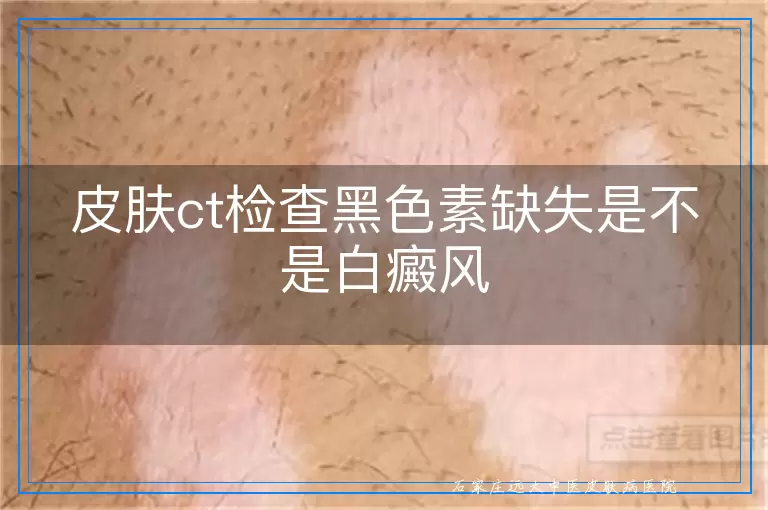 皮肤ct检查黑色素缺失是不是白癜风