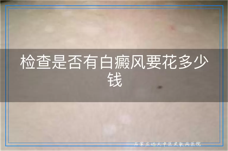 检查是否有白癜风要花多少钱