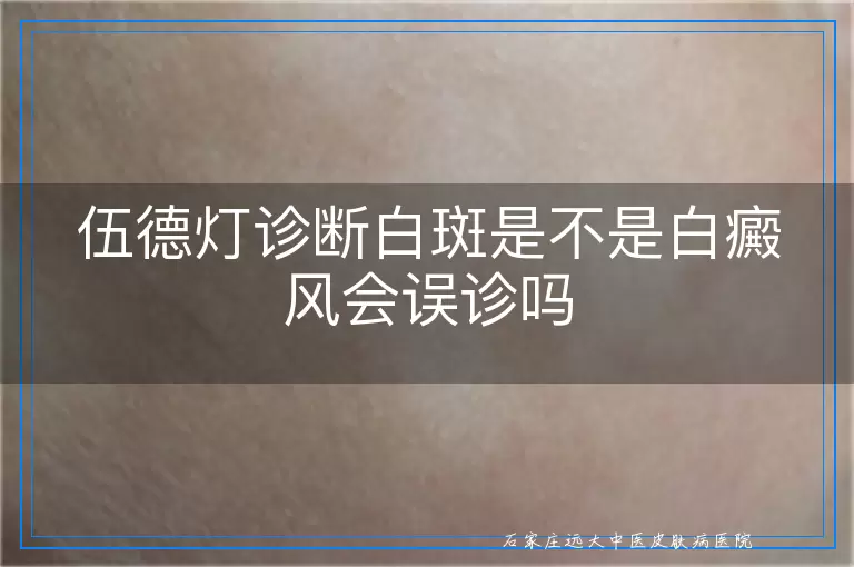 伍德灯诊断白斑是不是白癜风会误诊吗