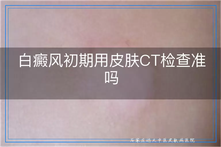 白癜风初期用皮肤CT检查准吗