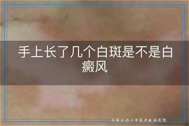 手上长了几个白斑是不是白癜风
