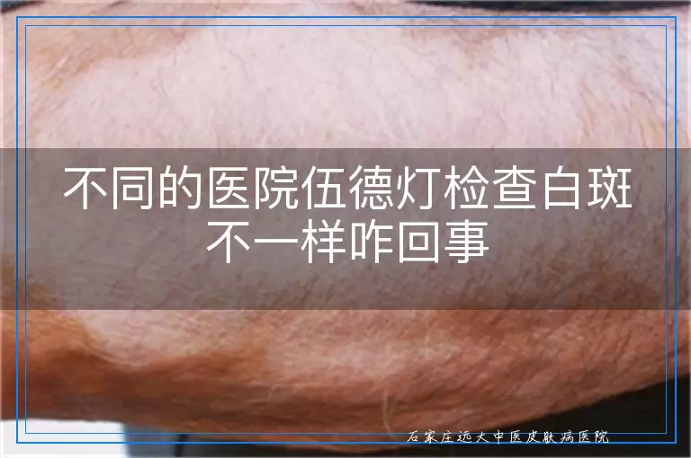 不同的医院伍德灯检查白斑不一样咋回事