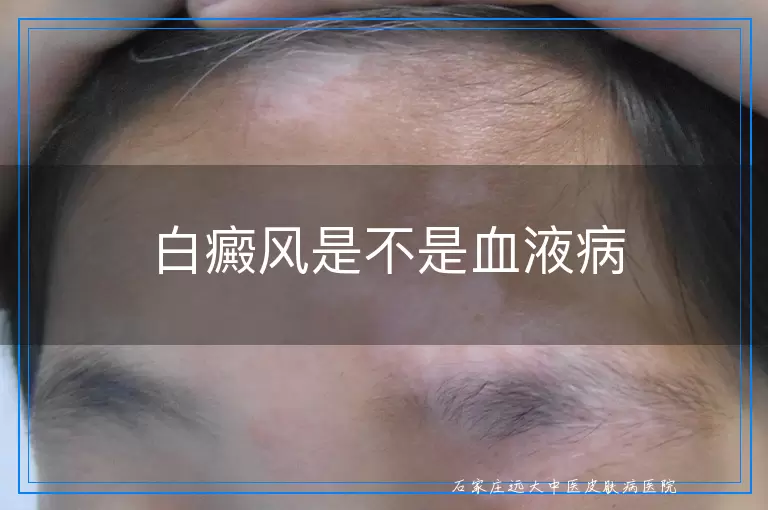白癜风是不是血液病