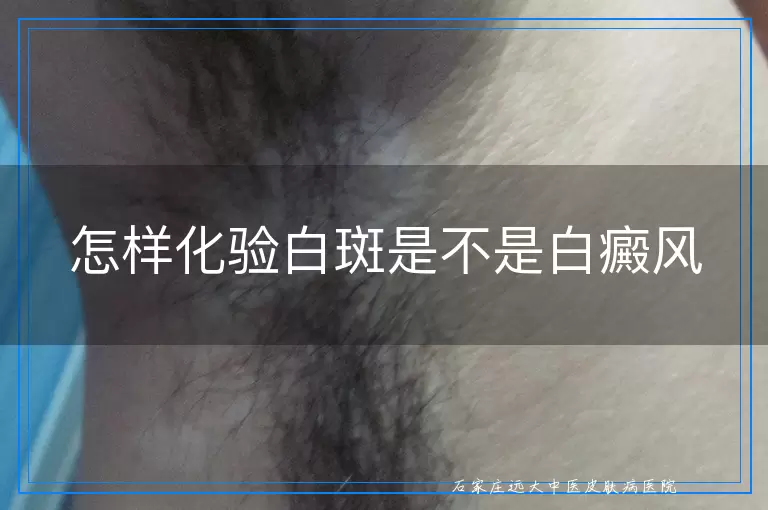 怎样化验白斑是不是白癜风