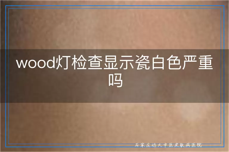 wood灯检查显示瓷白色严重吗