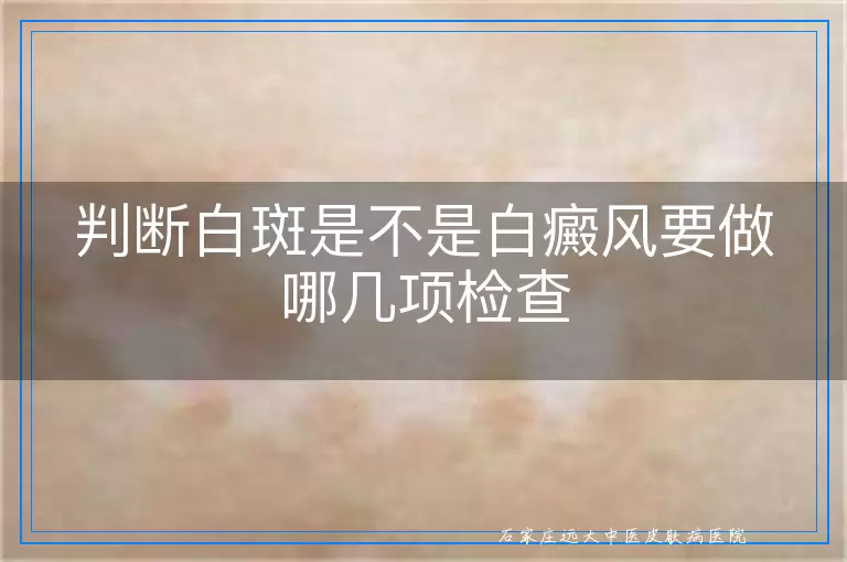 判断白斑是不是白癜风要做哪几项检查