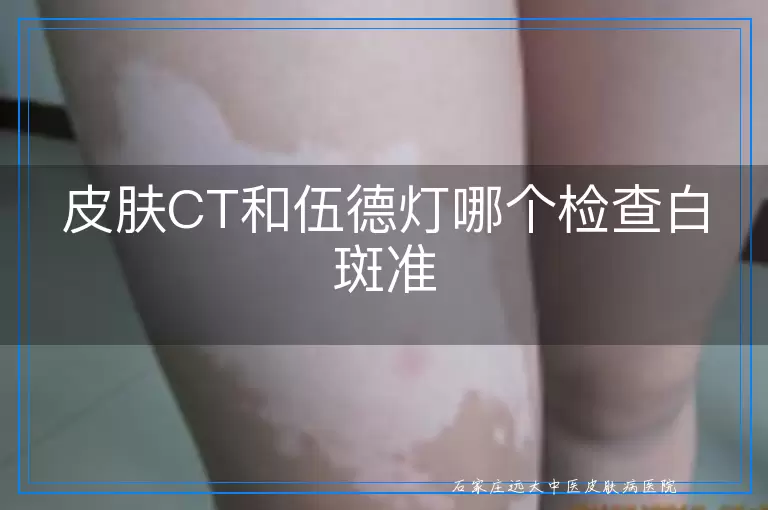 皮肤CT和伍德灯哪个检查白斑准