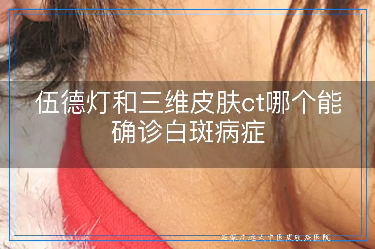 伍德灯和三维皮肤ct哪个能确诊白斑病症