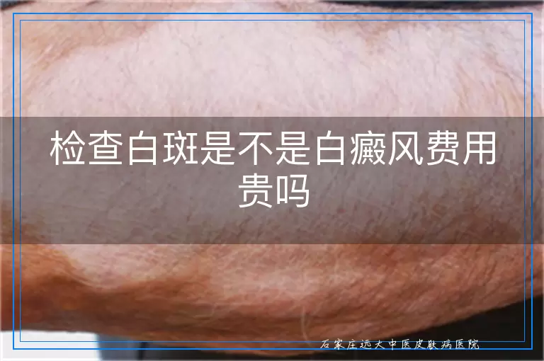 检查白斑是不是白癜风费用贵吗