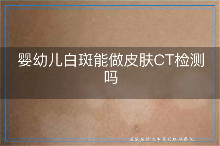 婴幼儿白斑能做皮肤CT检测吗