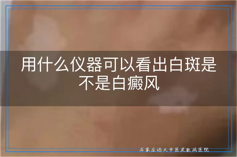 用什么仪器可以看出白斑是不是白癜风