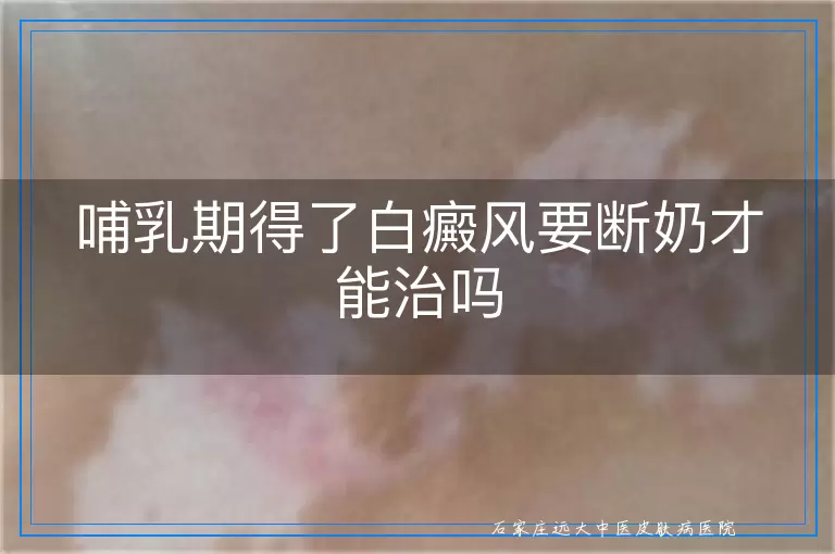 哺乳期得了白癜风要断奶才能治吗