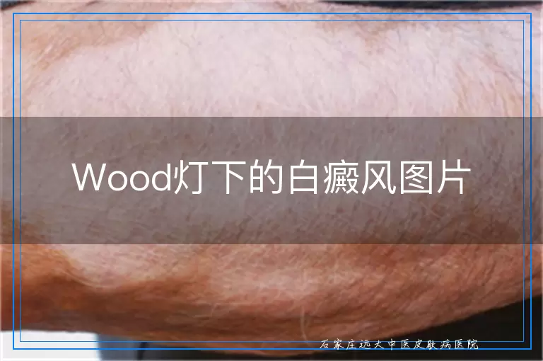 Wood灯下的白癜风图片