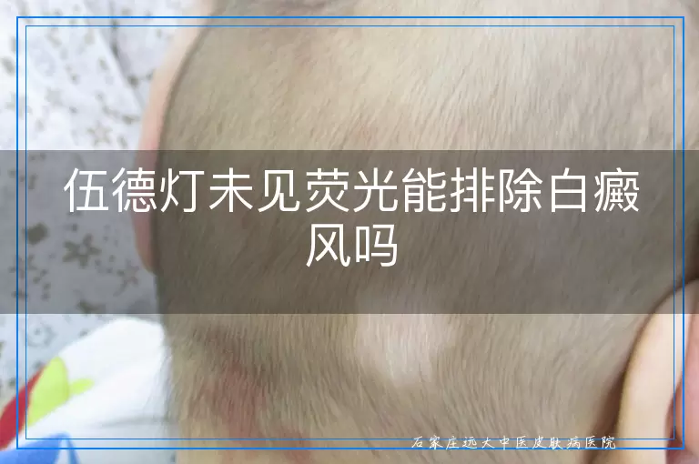 伍德灯未见荧光能排除白癜风吗