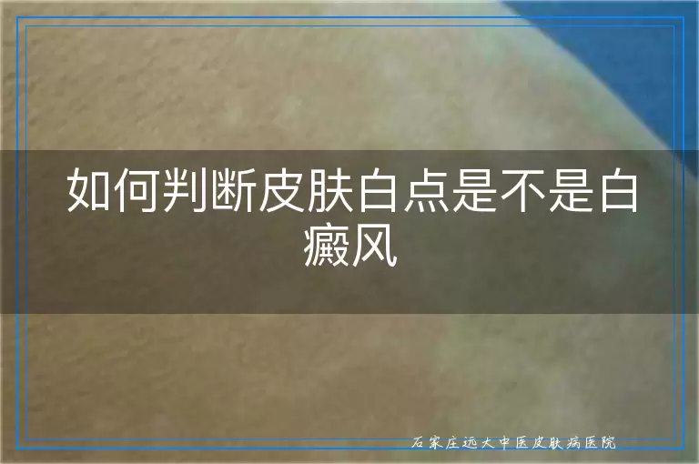 如何判断皮肤白点是不是白癜风