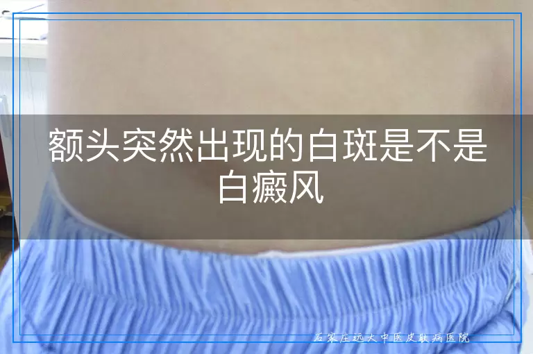 额头突然出现的白斑是不是白癜风