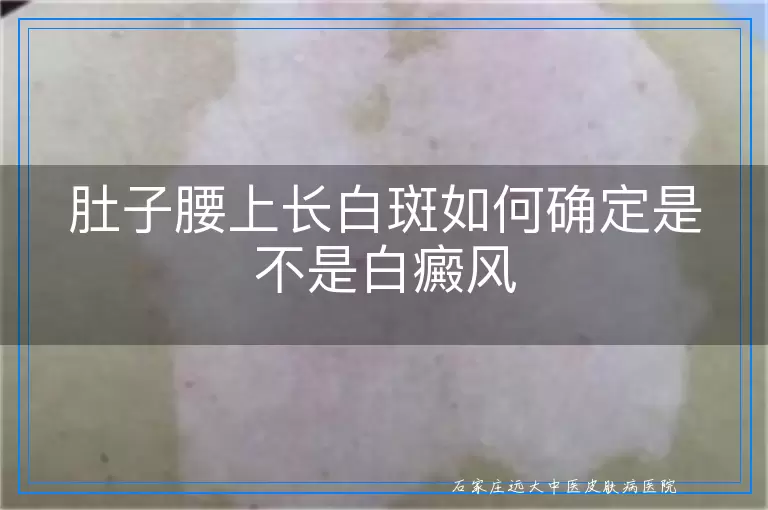 肚子腰上长白斑如何确定是不是白癜风