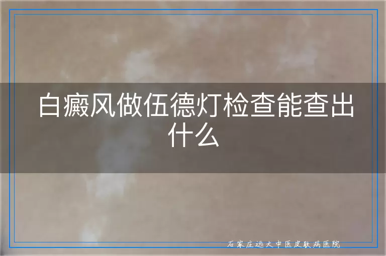 白癜风做伍德灯检查能查出什么