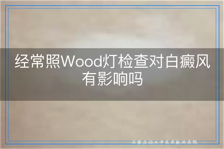 经常照Wood灯检查对白癜风有影响吗