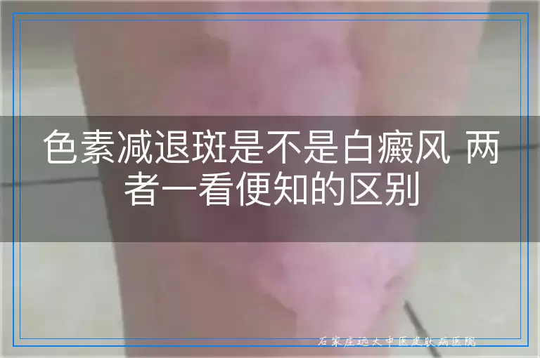 色素减退斑是不是白癜风 两者一看便知的区别