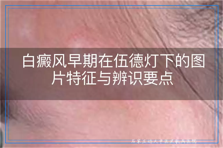 白癜风早期在伍德灯下的图片特征与辨识要点