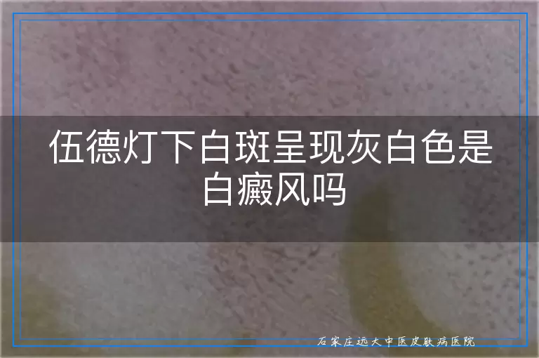 伍德灯下白斑呈现灰白色是白癜风吗