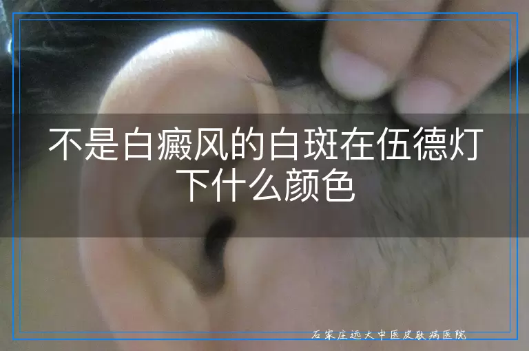 不是白癜风的白斑在伍德灯下什么颜色
