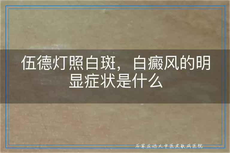 伍德灯照白斑，白癜风的明显症状是什么