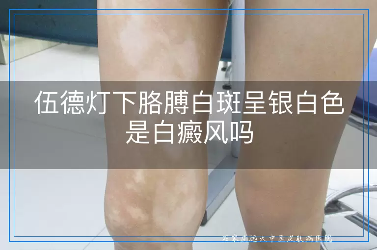 伍德灯下胳膊白斑呈银白色是白癜风吗