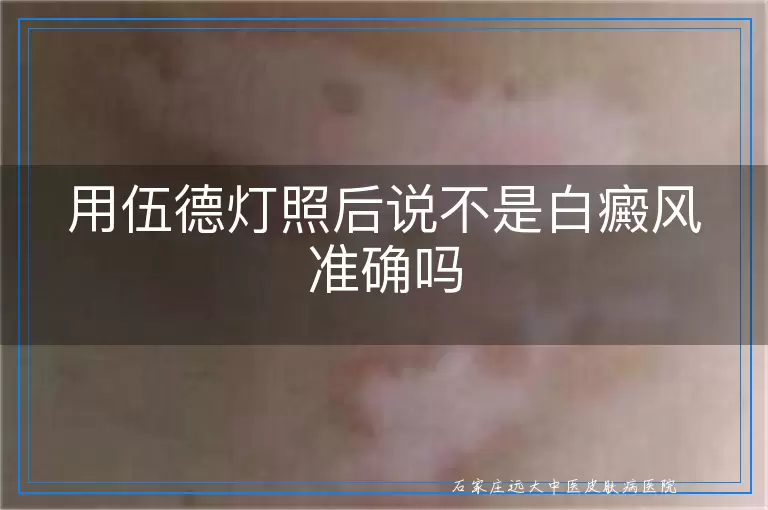 用伍德灯照后说不是白癜风准确吗