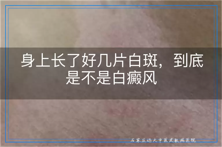 身上长了好几片白斑,到底是不是白癜风