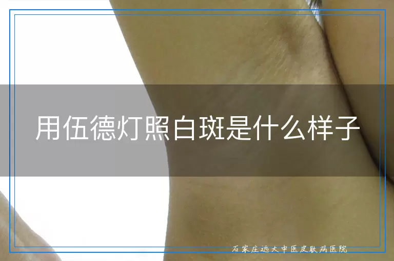 用伍德灯照白斑是什么样子