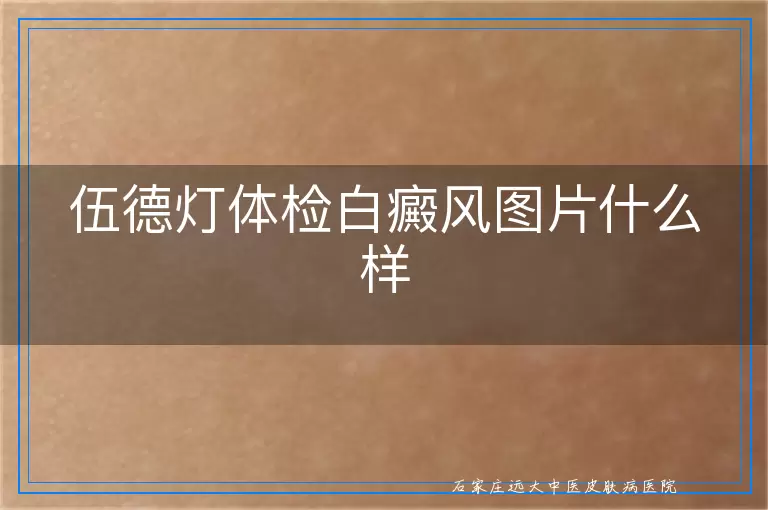伍德灯体检白癜风图片什么样
