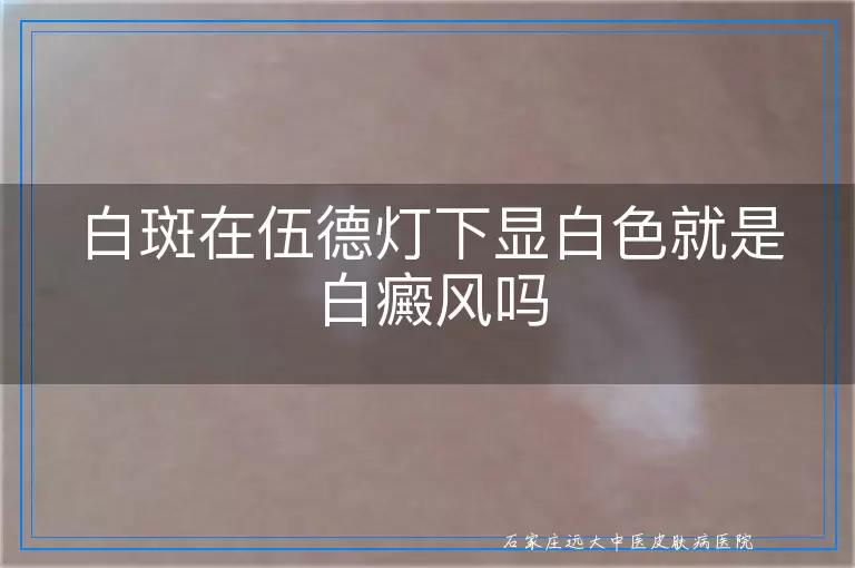 白斑在伍德灯下显白色就是白癜风吗