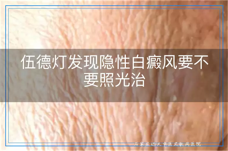 伍德灯发现隐性白癜风要不要照光治