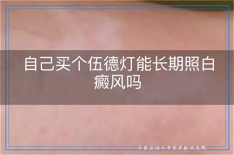 自己买个伍德灯能长期照白癜风吗