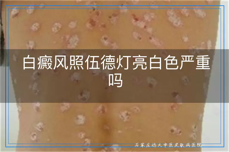 白癜风照伍德灯亮白色严重吗