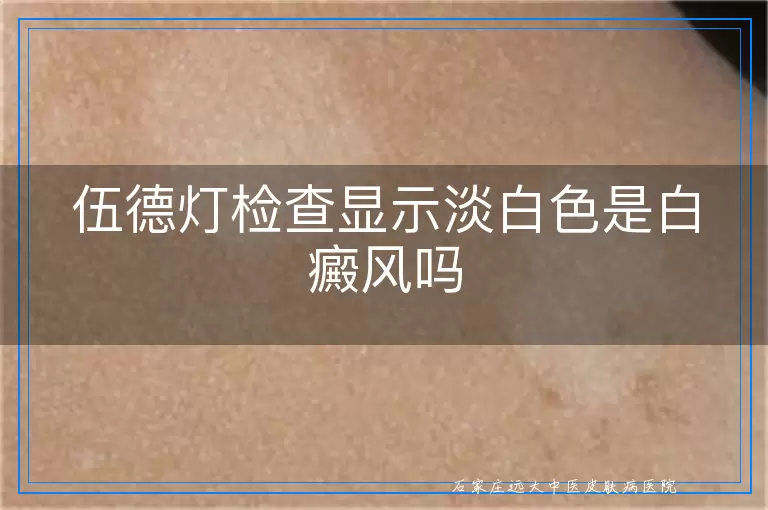 伍德灯检查显示淡白色是白癜风吗