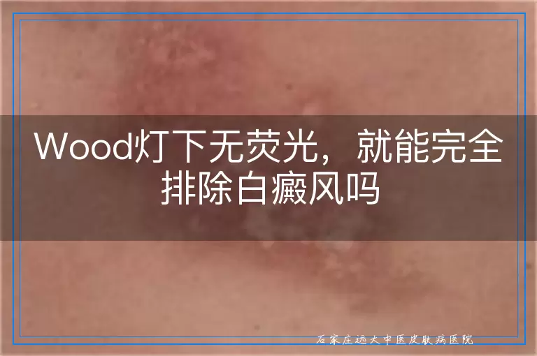 Wood灯下无荧光,就能完全排除白癜风吗
