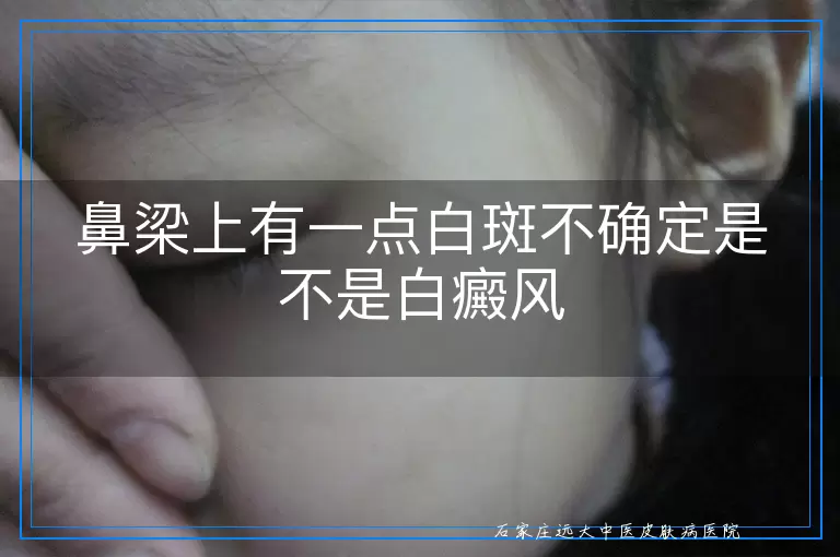 鼻梁上有一点白斑不确定是不是白癜风