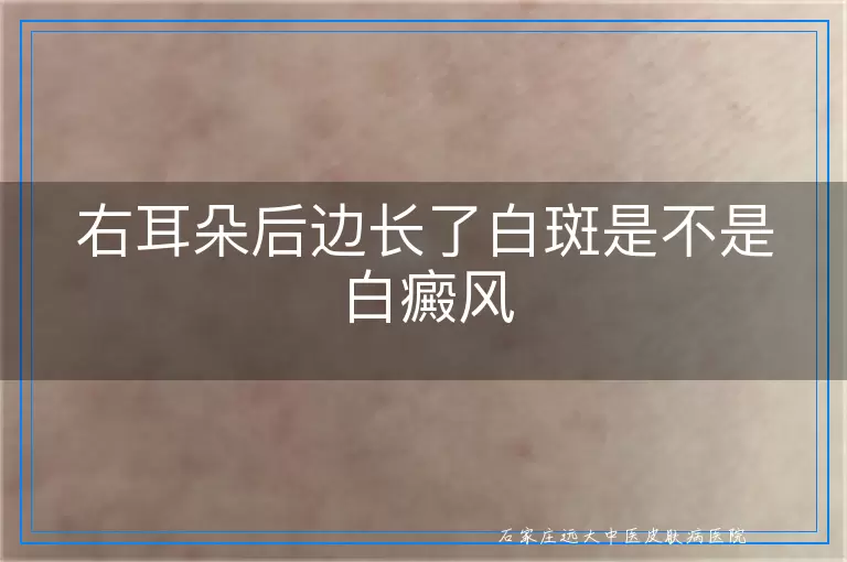 右耳朵后边长了白斑是不是白癜风